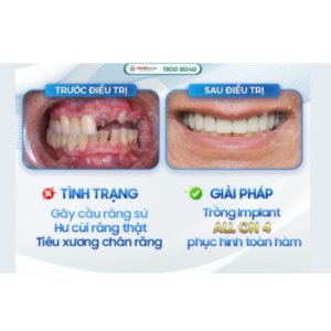Profile photo of Trồng Răng Implant